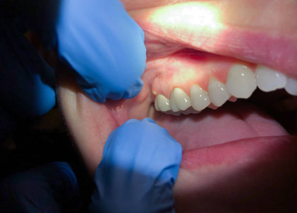 Best Emergency Treatment for Dental Infections or Abscesses in Simpsonville, KY